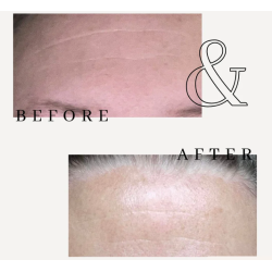 Fillerina Filler kur Grad 5 - inkl. GRATIS Dagcreme