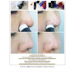 RiRe - All Kill Blackhead Remover Stick